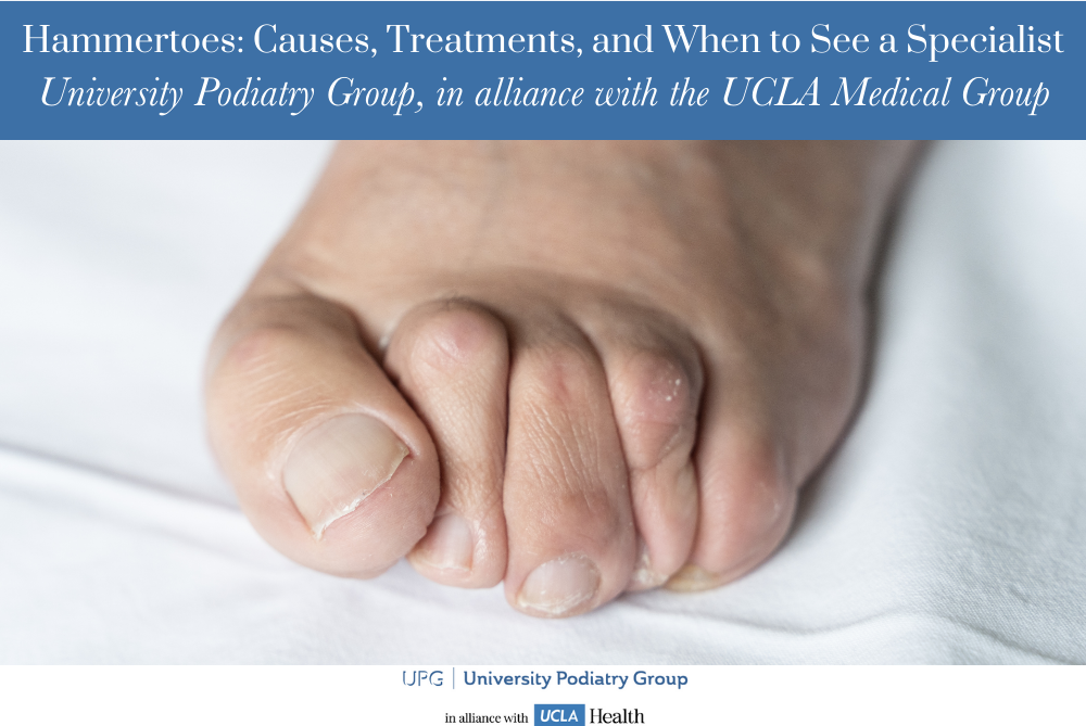 Hammertoes Causes, Treatments, and When to See a Specialist